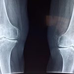 Berapa Biaya Operasi Lutut ACL dan Bagaimana Prosedurnya?